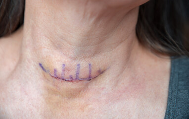 freshly sewn surgical wound after a thyroid operation