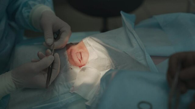 surgeon sutures eyelids of patient, blepharoplasty. High quality 4k footage