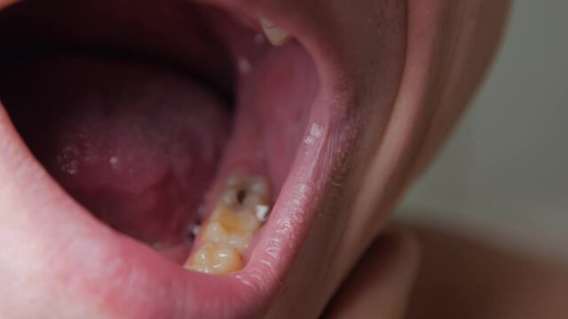Disease of teeth mouth closeup
