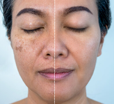 Retouched image to show before and after treatment spot melasma pigmentation facial treatment on young asian woman face. Skincare and health problem concept.	