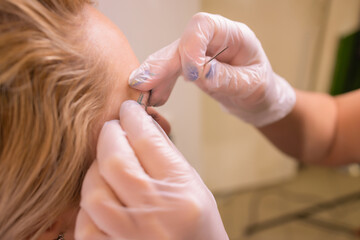 Professional placing the jewel of piercing on the temple on the head with ball. Tragus type.