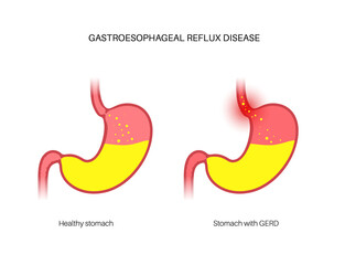 Obraz premium Gastroesophageal reflux disease