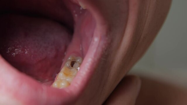 Sick tooth closeup mans mouth