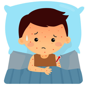 a child has smallpox