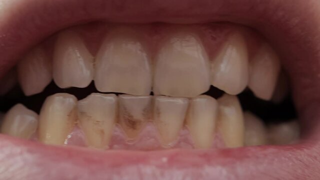 Rotten human teeth, close-up. Dental calculus in dentistry, black tooth, problema