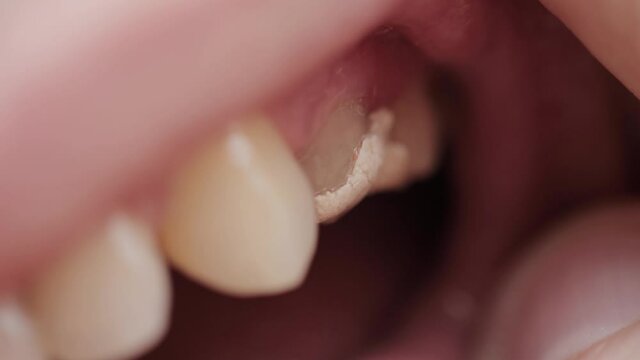 Temporary fillings on teeth after pulpitis treatment. Temporary fillings in dentistry, macro