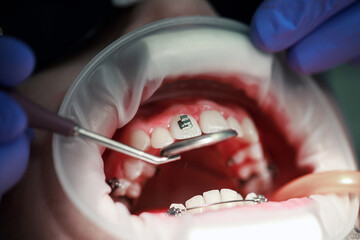 Installation of braces on the upper teeth. Treatment by an orthodontist. Focus on braces. Selective Sharpness.