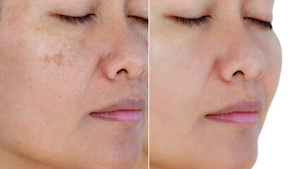 Image before and after spot melasma pigmentation facial treatment on middle age asian woman face....
