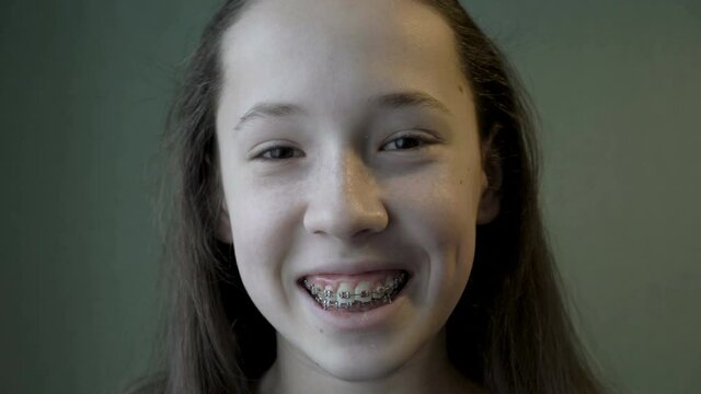 A cute, smiling teenage girl looks into the camera and shows metal braces in her mouth. Close-up of a child's face and mouth with braces. 4K