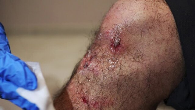 bleeding knee wound disinfection close-up - coucasian male hairy leg and female hand which disinfects with hydrogen peroxide