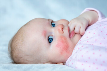 Newborn baby face with allergic reaction on skin. - obrazy, fototapety, plakaty