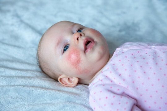 Newborn Baby Girl With Red Skin Rash, Dermatitics Syndrom