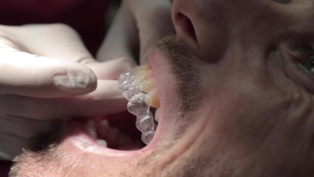 Close up application of transparent aligner on the patient's teeth in a dental office