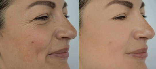 woman face wrinkles before and after treatment