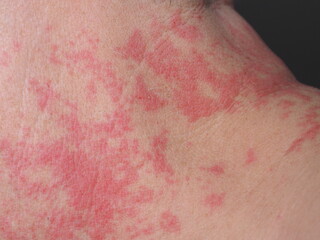 Fototapeta premium red spots allergy irritation on a man's neck
