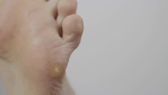 plantar wart on the sole of a man's foot on a white background, macro. Copy space for text