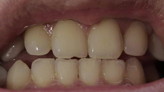 The man has yellow teeth in his mouth. Teeth whitening concept in modern dentistry, macro