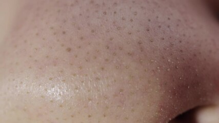 Oily skin on the nose of a person with blackheads and acne. Facial skin care, dermatology, macro