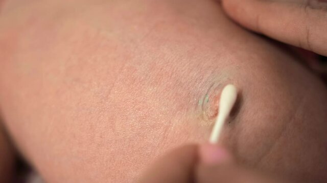 Mother treats newborn's navel with antibacterial cotton bud. Nurse cleans baby's bellybutton of clotted blood, dirt. Umbilicus of infant. Closeup. Care hygiene for white 1 month suckling. Pediatrician