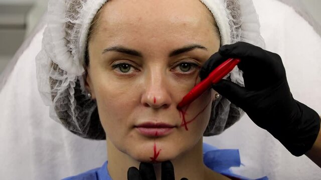 Marking with a marker, for face correction with fillers