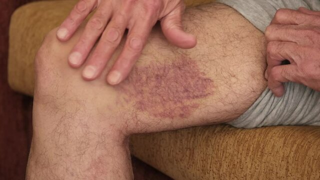 Close-up of a large bruise on a senior man's leg. bed sores and bruises as a result of old age.