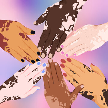 Hands of different ethnicities and skin conditions together