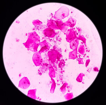 Gram stain microscopic slide, plenty epithelial cells, few pus cells, diplococci and fungal hyphae, 40x view