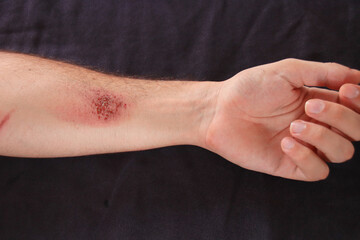 Left hand suffering from skin abrasion injury against a black background