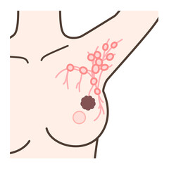 センチネルリンパ節生検の解説イラスト