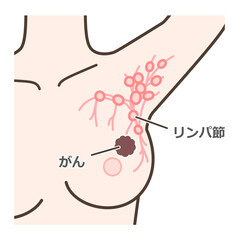 センチネルリンパ節生検の解説イラスト