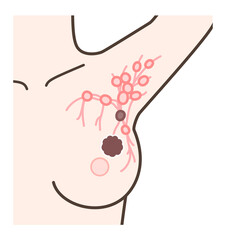 センチネルリンパ節生検の解説イラスト