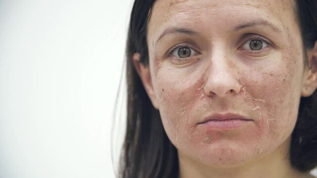 4k slowmotion close up video of female face with skin problems.