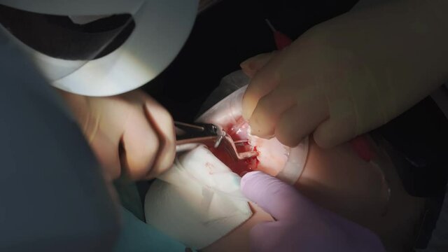 real. dentist pulls out a sick wisdom tooth. 