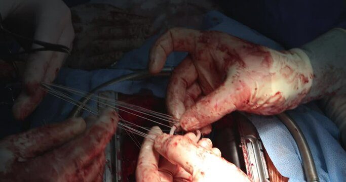 Close Up heart surgeon doctor operation heart surgery intervention close-up replace valve open cord surgery minimally invasive surgery