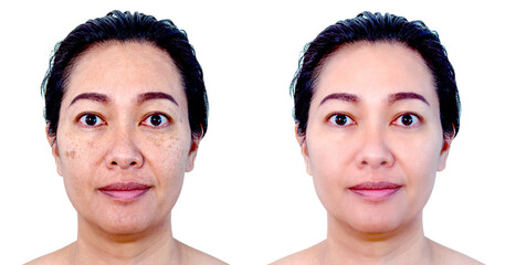 Image before and after spot melasma pigmentation facial treatment on middle age asian woman face...