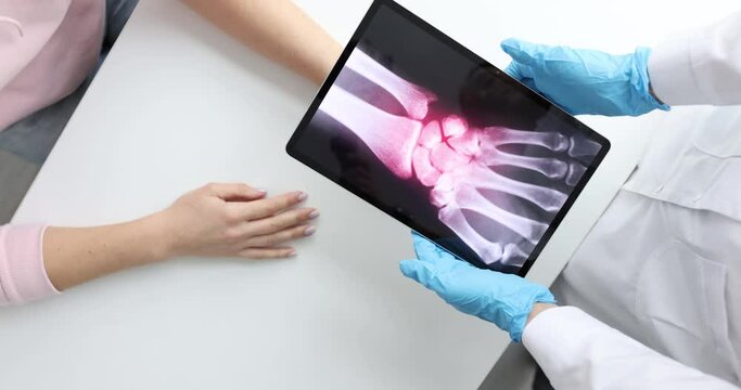 Inflammation of bones of hand on x-ray of patient slow motion 4k movie