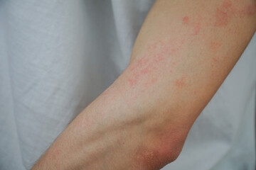 Red rush on the skin of a arm
