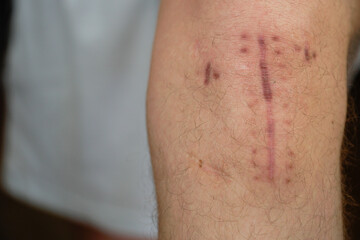 Big scar under a knee cap after surgery