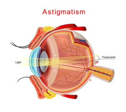 Illustration of astigmatism. Astigmatism is a blurred vision. Anatomy of the eye, cross section. Isolated Vector.