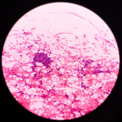 Squamous cell carcinoma of lung, malignant cells, sample aspirate from lung mass by CT guided FNA....