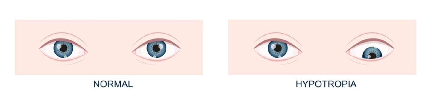 Hypotropia. Vertical strabismus. Human eyes healthy and with downward gaze position. Double vision. Vector cartoon illustration.