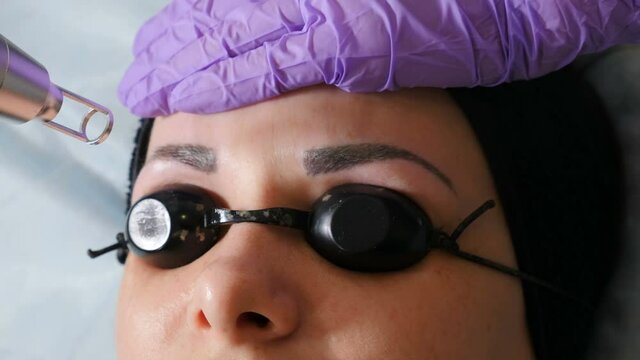 Laser eyebrow tattooing removing. Permanent make-up and tattoos removal. Getting rid of permanent makeup in salon. Female client getting eyebrows tattoo correction. picosecond laser device. 4 k video