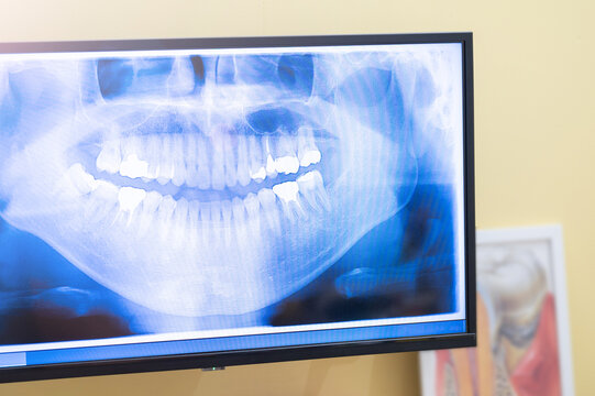 Image of a digital x-ray in a dental clinic
