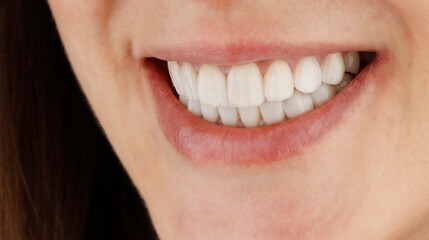 Smile design with laminate veneers.