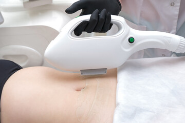 laser hair removal process