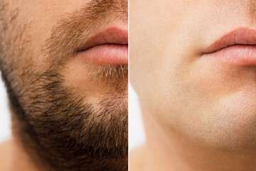 Close up photo of a man's face before and after shaving. a young man with a beard. Comparison of a...