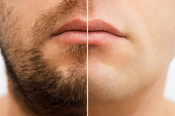 Close up photo of a man's face before and after shaving. a young man with a beard. Comparison of a man's face with a beard and without a beard. use of aftershave cream.