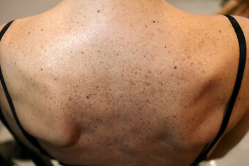 Fototapeta premium skin blemish on the back of a young caucasian girl - sun disease