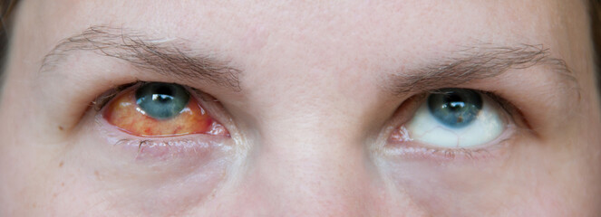 The woman's right eye is sick with keratitis. The fibrous tunic of eyeball is red. The woman rolled...