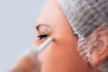 White pencil markings on the patient's face for botox injection in the eye